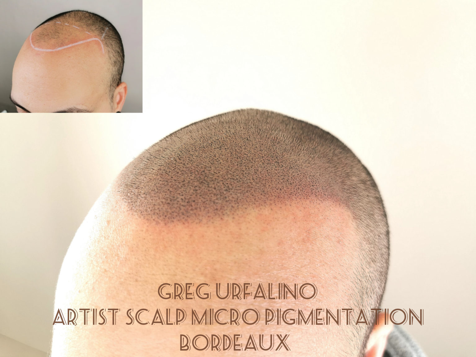 Greg Urfalino artist smp bordeaux #tricopigmentation #tricopigmentationbordeaux #smpbordeaux